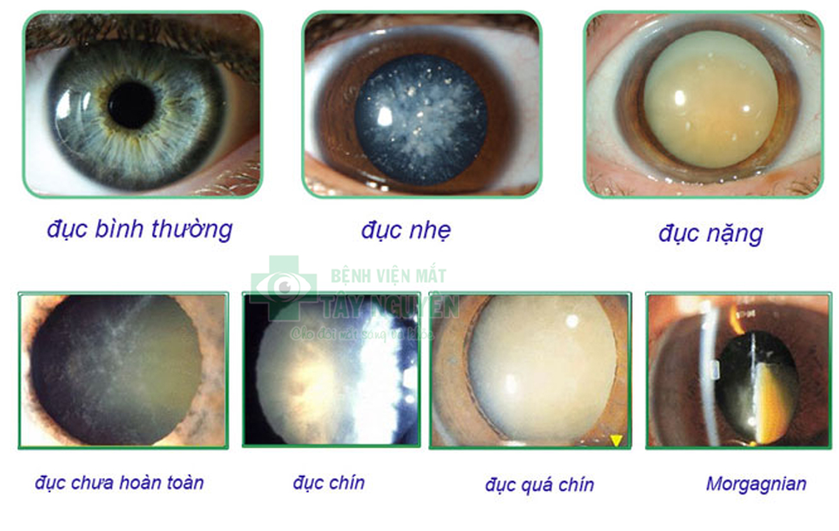 Các loại đục thủy tinh thể ở mắt là gì?